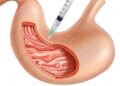 Mide Botoksu – Mide Balonu nedir?