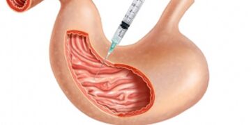 Mide Botoksu – Mide Balonu nedir?