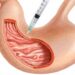 Mide Botoksu – Mide Balonu nedir?