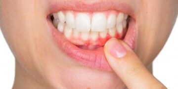 Diş eti apsesi neden olur? Dr. Berkan Yıldız anlatıyor