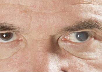 Katarakt nedir? Prof. Dr. Kadir Can Keskinbora anlatıyor