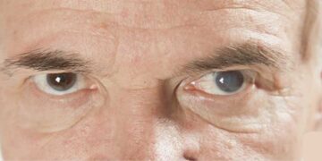 Katarakt nedir? Prof. Dr. Kadir Can Keskinbora anlatıyor