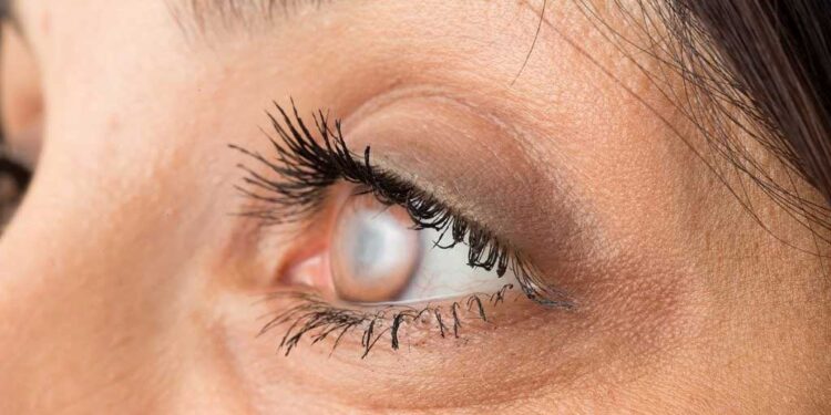 Katarakt nedir? Nasıl tedavi edilir? Op. Dr. V. Emre Erden açıklıyor