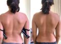 Skolyoz nedir? Tedavisi nasıl yapılır? Dr. Cem Karabulut anlatıyor