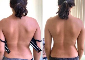 Skolyoz nedir? Tedavisi nasıl yapılır? Dr. Cem Karabulut anlatıyor