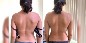 Skolyoz nedir? Tedavisi nasıl yapılır? Dr. Cem Karabulut anlatıyor