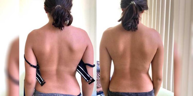 Skolyoz nedir? Tedavisi nasıl yapılır? Dr. Cem Karabulut anlatıyor