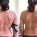 Skolyoz nedir? Tedavisi nasıl yapılır? Dr. Cem Karabulut anlatıyor