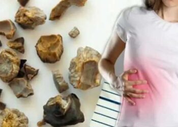 Taş hastalığı nedir? Dr. Ülküsan Özer anlatıyor