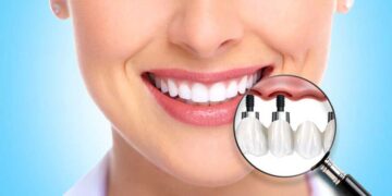 Immediate implant nedir? Diş Hekimi Berkan Yıldız anlatıyor