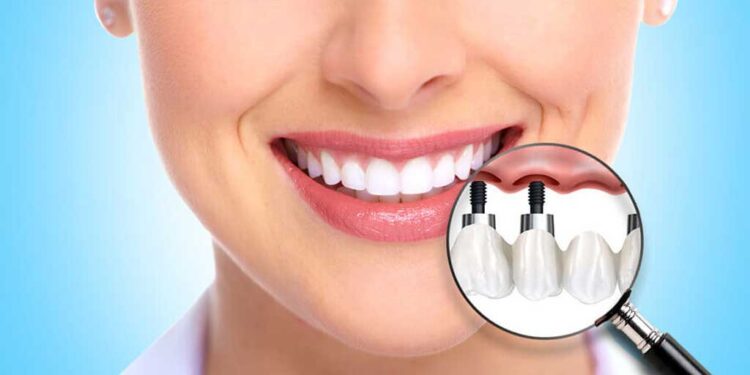 Immediate implant nedir? Diş Hekimi Berkan Yıldız anlatıyor