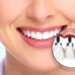 Immediate implant nedir? Diş Hekimi Berkan Yıldız anlatıyor