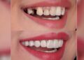 Implant mı yaptırmanız gerekiyor! Tüm detayları Dr. Yücel Yetik anlatıyor