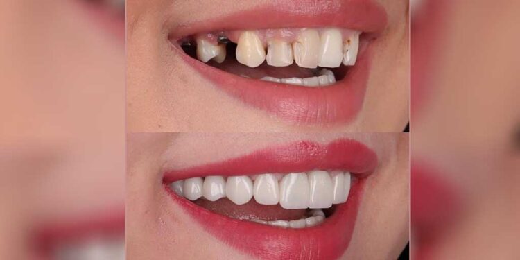 Implant mı yaptırmanız gerekiyor! Tüm detayları Dr. Yücel Yetik anlatıyor